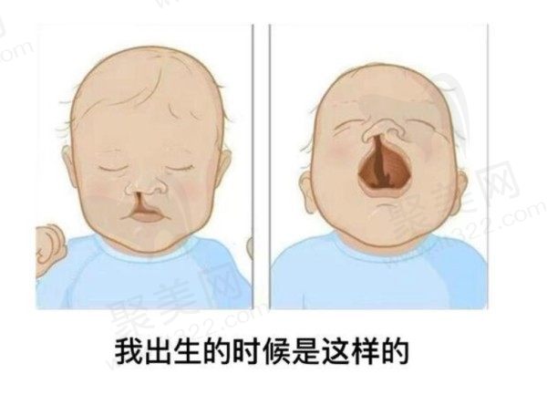 貴陽(yáng)利美康梁安裕唇裂二期修復(fù)怎么樣？技術(shù)在線(xiàn)還可同時(shí)改善唇裂+鼻畸形2w元起