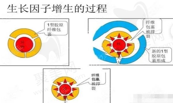 广州海峡整形异物取出可信度高，彭栋梁四维清异术技术实力强