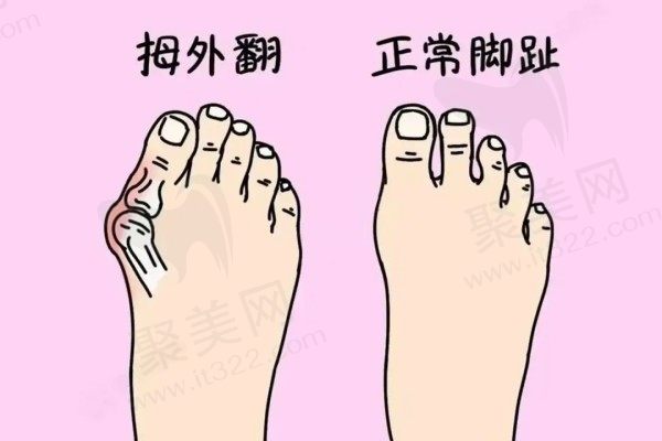 苏敬达和马桂文谁做大脚骨好？两位医生技术特色与费用全方面对比