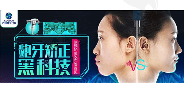 广州曙光口腔龅牙矫正黑科技