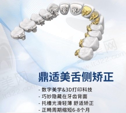 鼎适美舌侧矫正