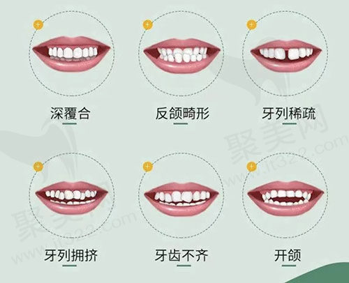 牙齿畸形