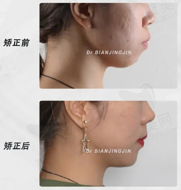 沈阳矫正牙齿卞晶晶医生正畸病例展示