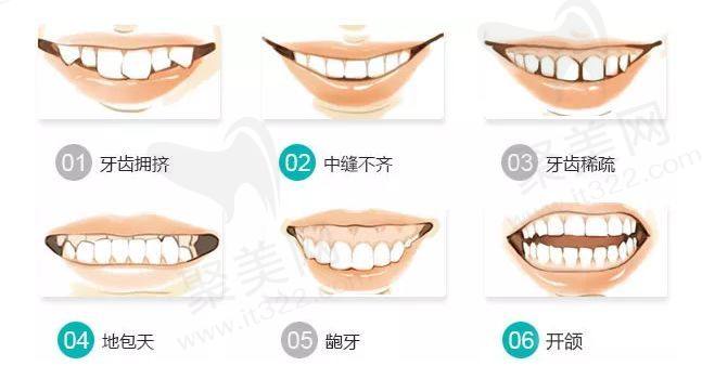 牙齿矫正