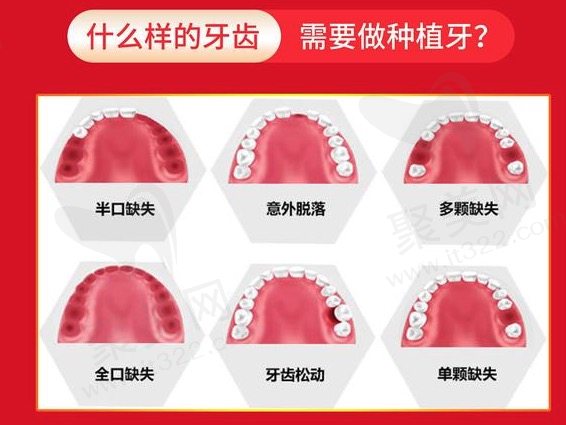 什么样的牙齿需要种植牙