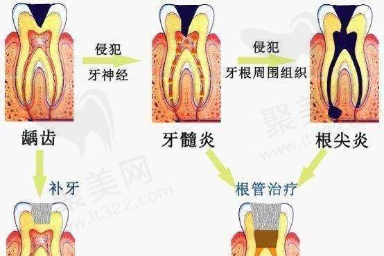 根管治疗