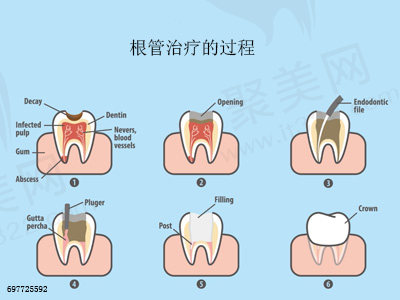 根管治疗