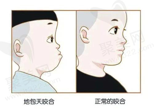 儿童反颌