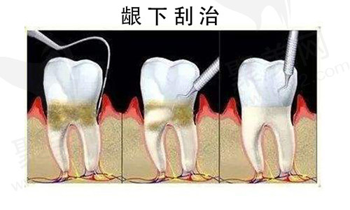 龈下刮治