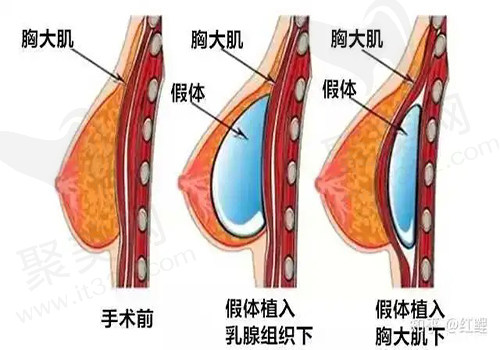 假体隆胸手术