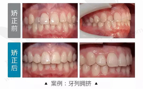 牙齿矫正