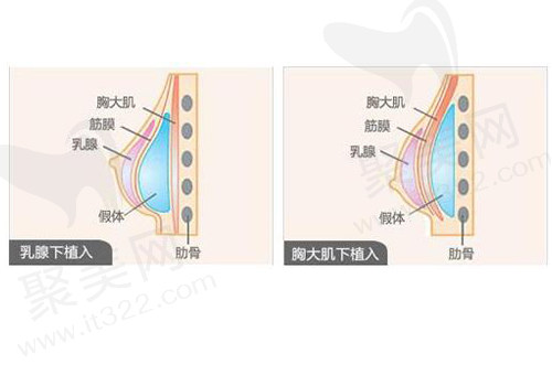假体隆胸手术示意图