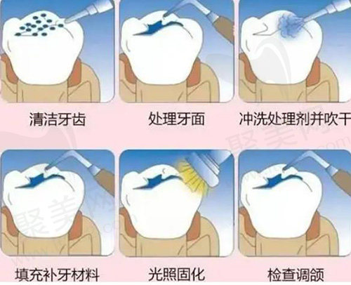 补牙过程