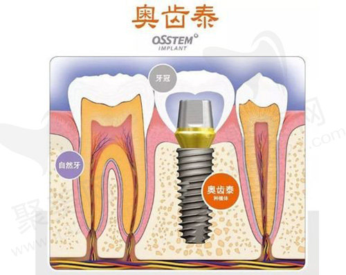 韩国奥齿泰种植体
