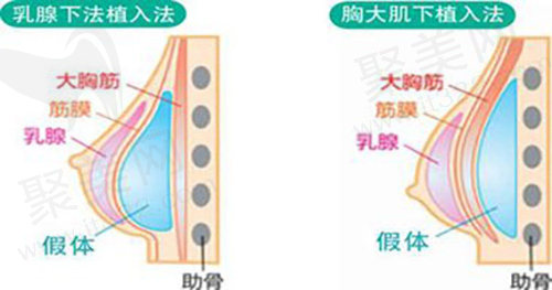 隆胸