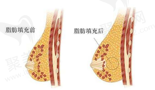 隆胸