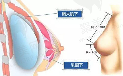 隆胸