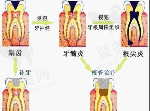 根管治疗