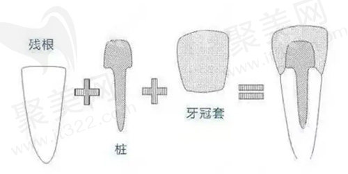 打牙桩修复过程