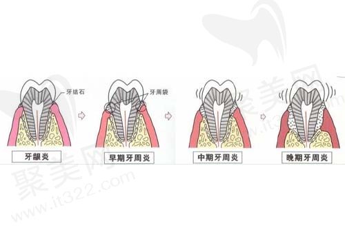 牙周炎发展过程