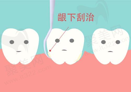 龈下刮治