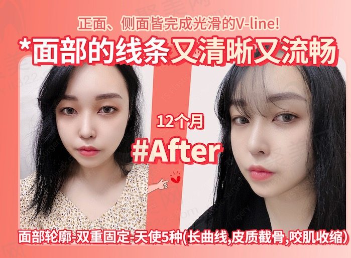 韩国TS面部轮廓双重固定术后九个月