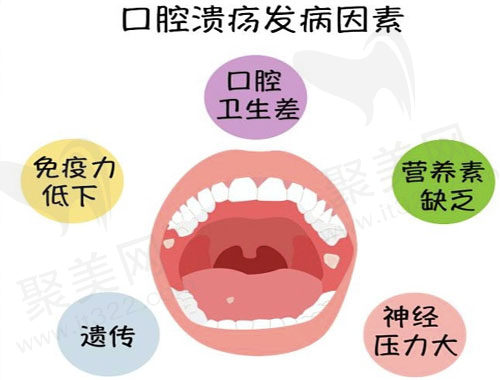 口腔溃疡