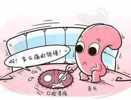口腔溃疡