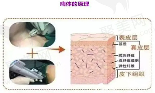 嗨体