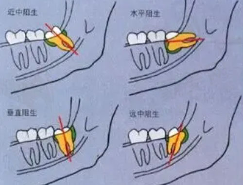 智齿牙龈发炎肿痛
