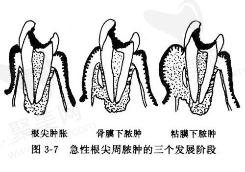 急性根尖周炎发展阶段