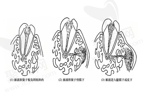 根尖周炎的三个阶段