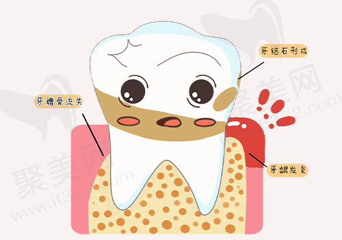 牙尖周炎