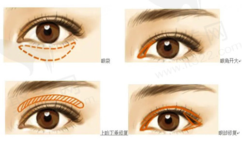 眼综合