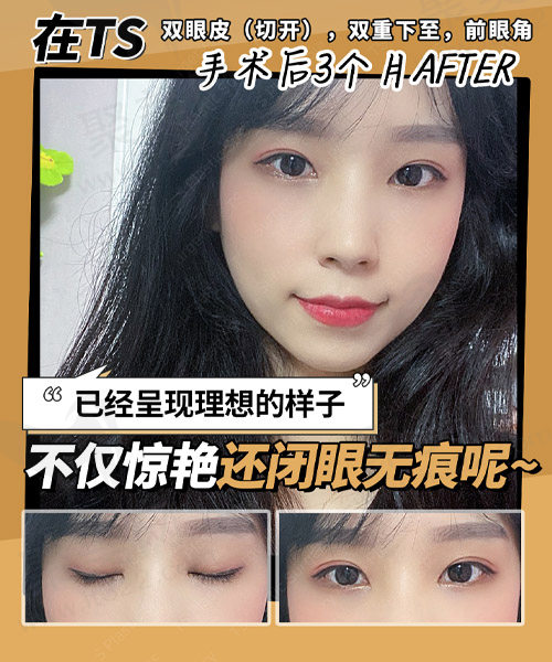 术后三个月变化