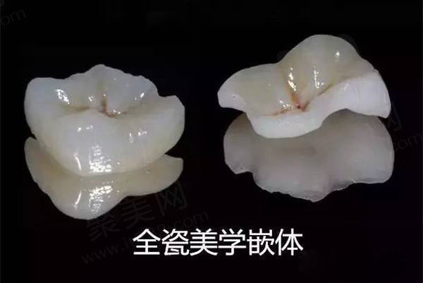 嵌体补牙后悔一辈子