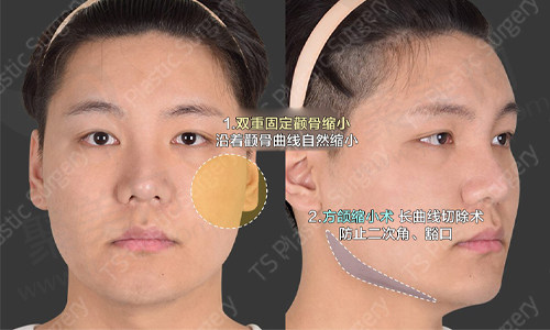 术前术后变化