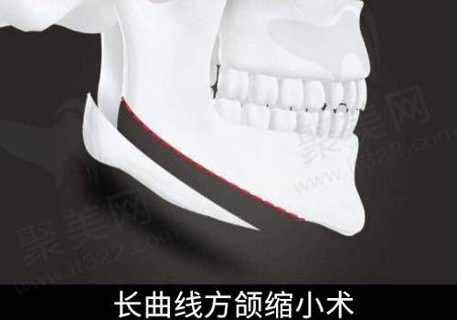 长曲线缩小术