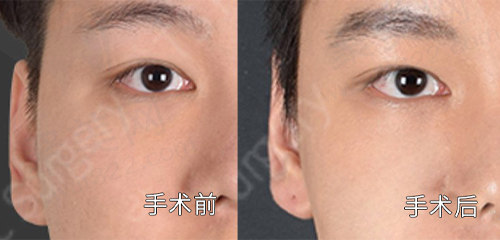 术前术后对比