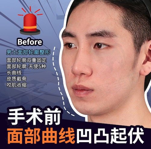 韩国TS李相均男士面部轮廓手术做的怎么样
