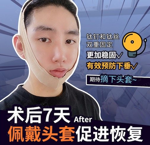 韩国TS李相均男士面部轮廓手术后7天
