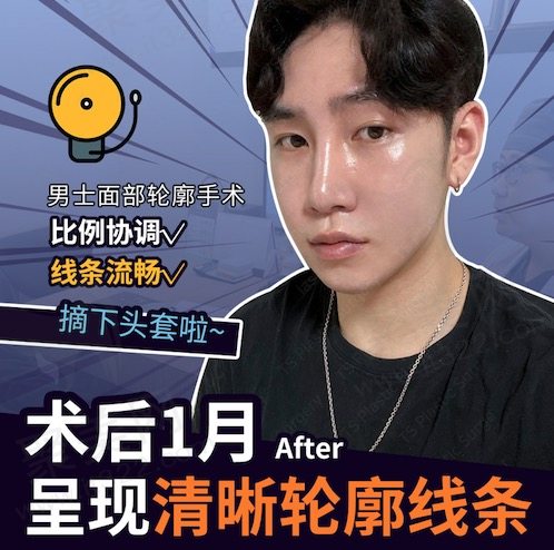 韩国TS李相均男士面部轮廓手术后一个月