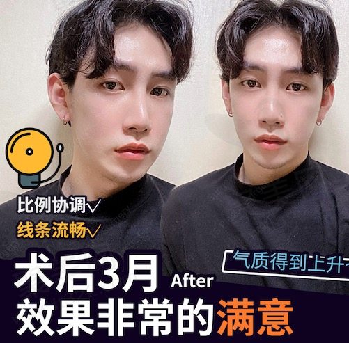 韩国TS李相均男士面部轮廓手术后三个月
