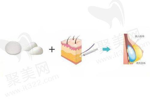 假体隆胸过程