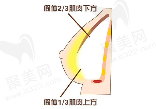 假体示意图