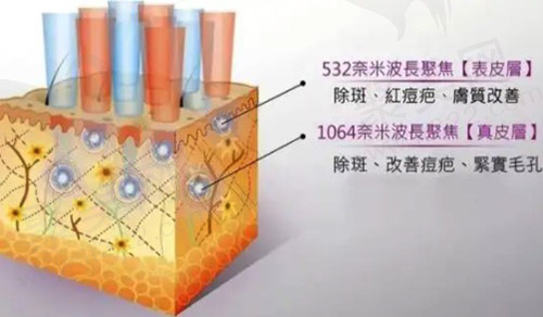超皮秒全脸淡斑