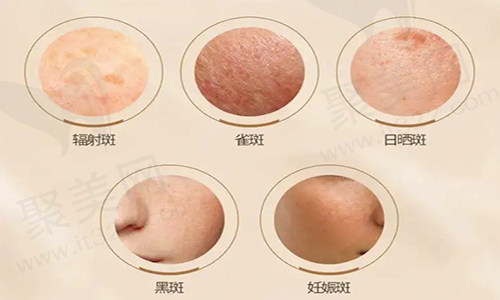 超皮秒全脸淡斑