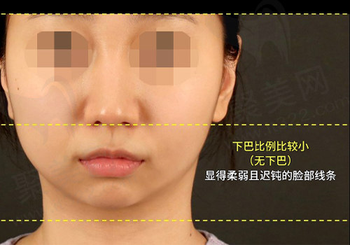 下巴整形前