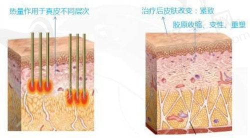 热玛吉