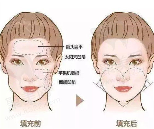 苹果肌填充